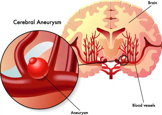 Intracranial Aneurysm Treatment Sydney