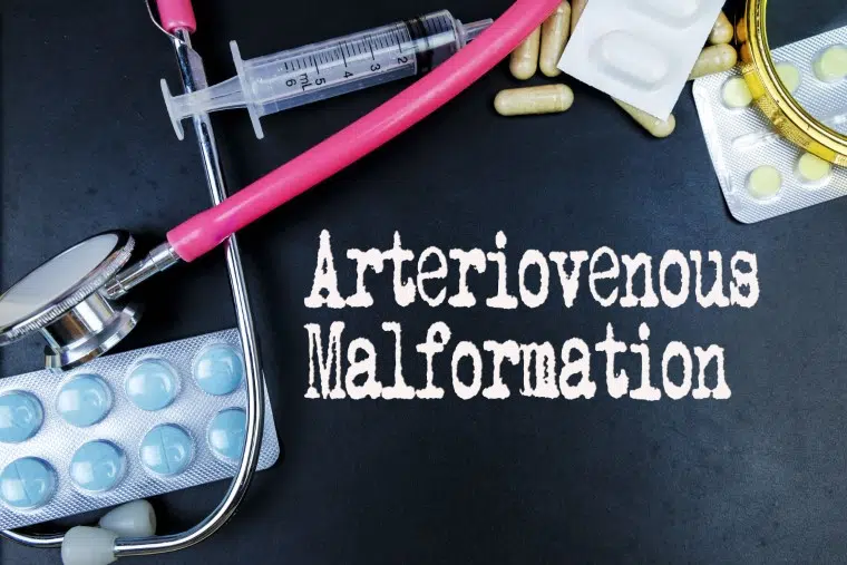 arteriovenous malformations treatment sydney