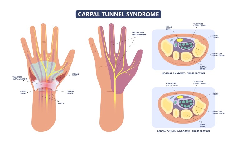 carpal tunnel syndrome in sydney - CURA Medical Specialists